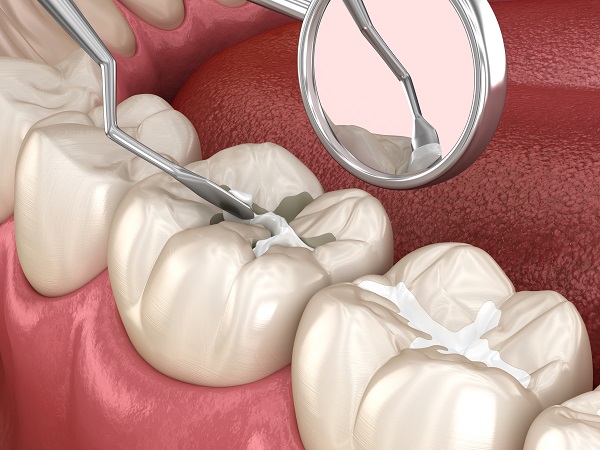 Are Dental Sealants A Good Preventative Treatment?