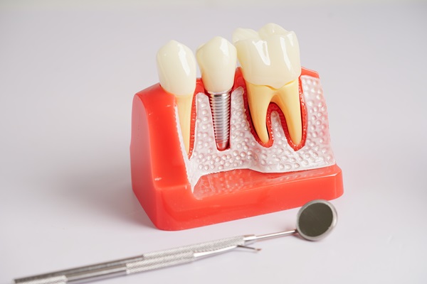 Aftercare Tips For Implant Crowns